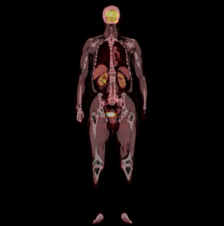 PET-CT