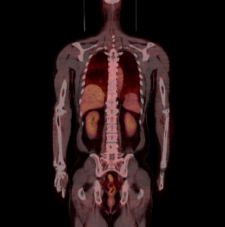 PET-CT