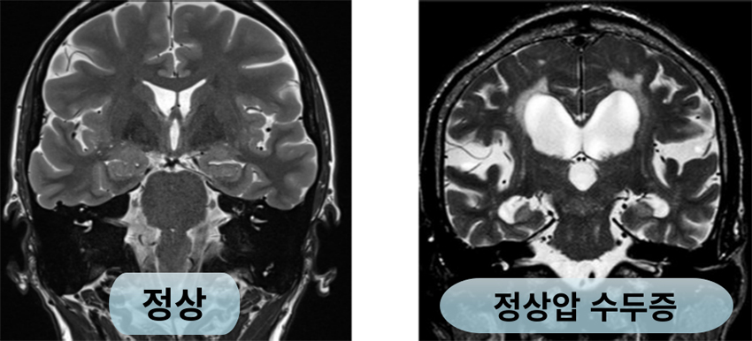 수두증 클리닉 이미지