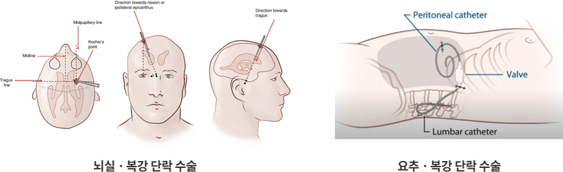 수두증 클리닉 이미지