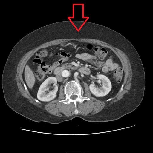서양배형 내장 비만 ct사진