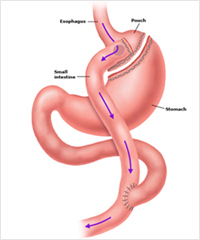 루와이 위우회술 사진
