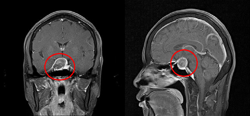 뇌하수체 선종 이미지