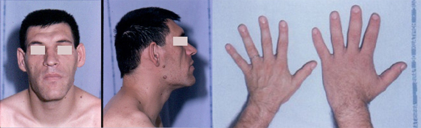 말단비대증 이미지