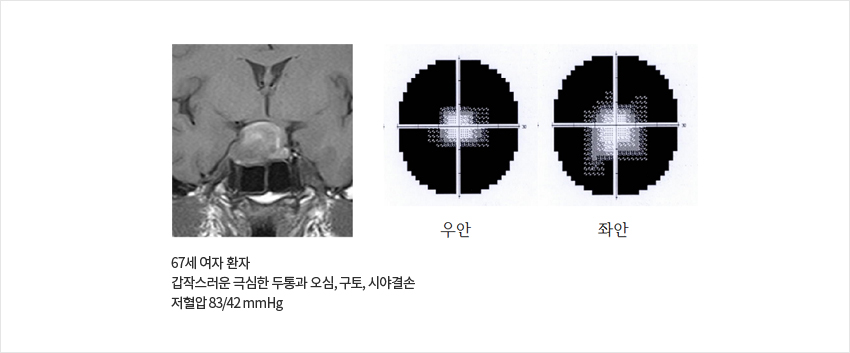 67세 여자 환자 갑작스러운 극심한 두통과 오심, 구토, 시야결손, 저혈압 83/42 mmHG, 우안, 좌안 이미지