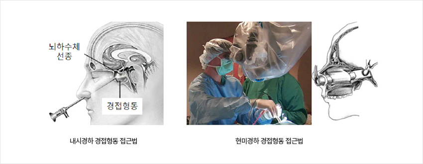 내시경하 경정형동 접근법, 현미경하 경접형동 접근법 이미지